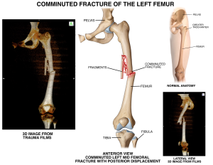 Fractured Bones Illustrated