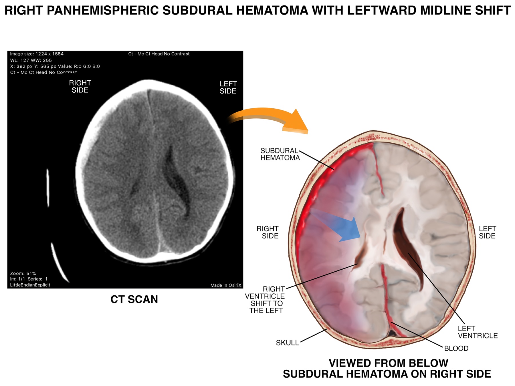 Subdural hematoma illustration next to the client CT scan