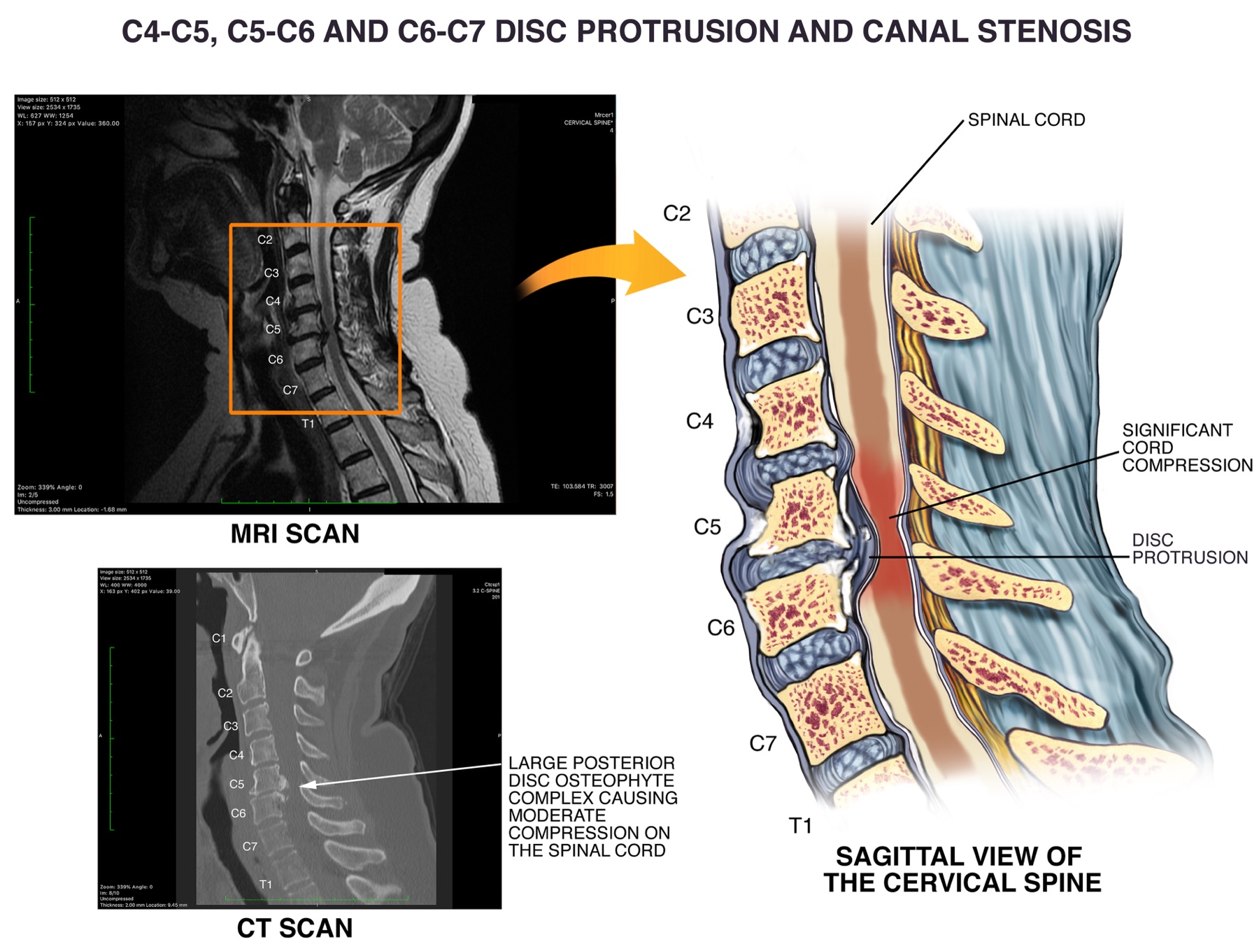 Medical illustration of C4–C7 disc protrusion and canal stenosis correlated to MRI and CT