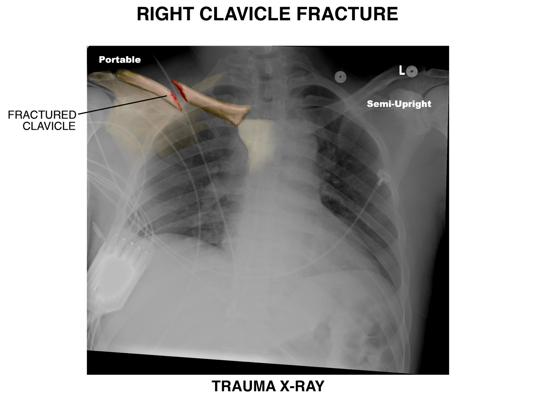 Trauma x-ray with illustrated overlay of a fractured clavicle