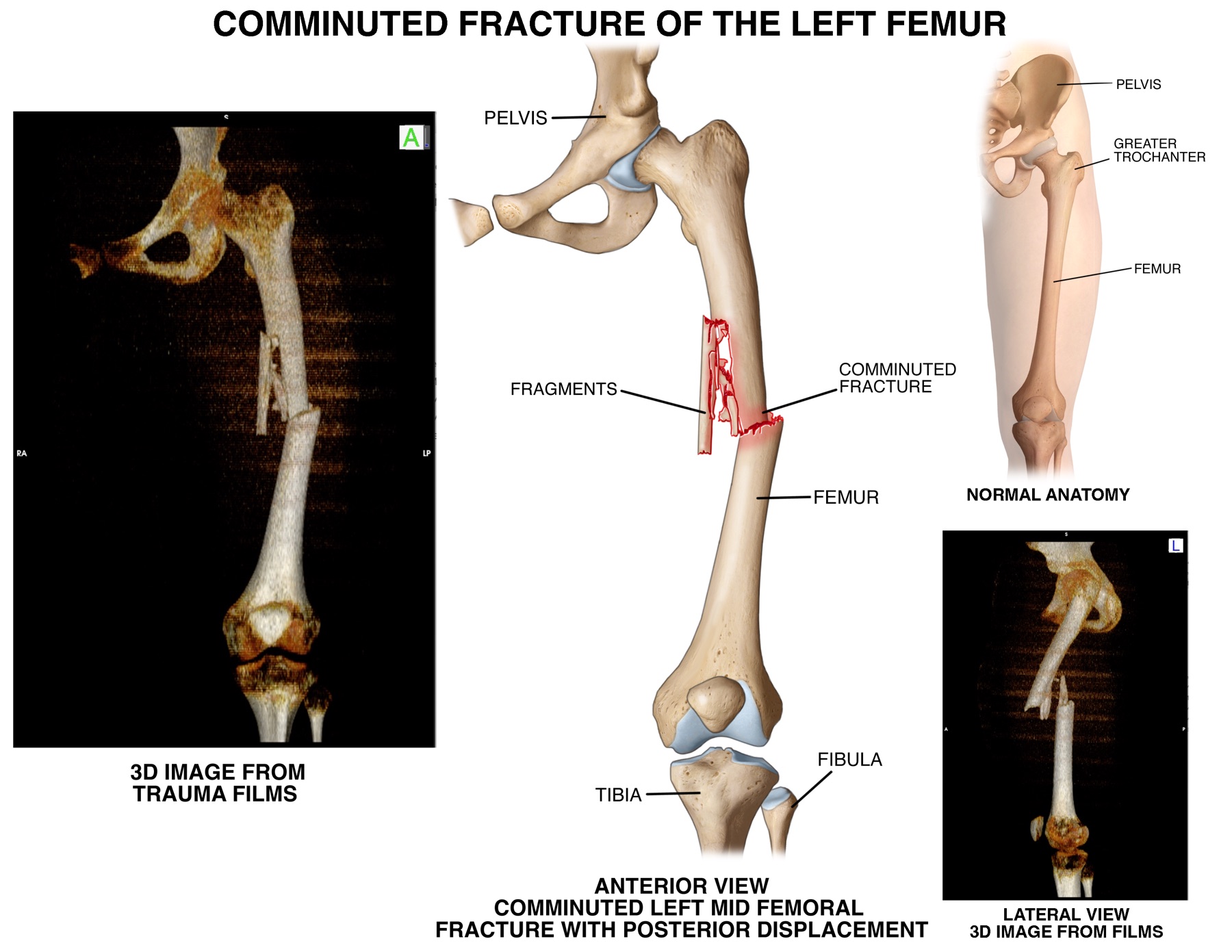Comminuted left femur fracture illustrated from 3D trauma films