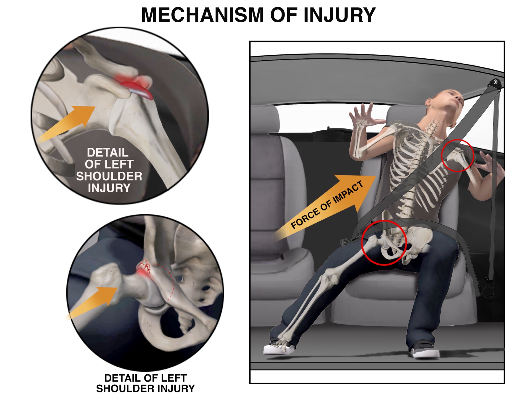 Mechanism of injury exhibit showing seatbelt forces on the shoulder and hip