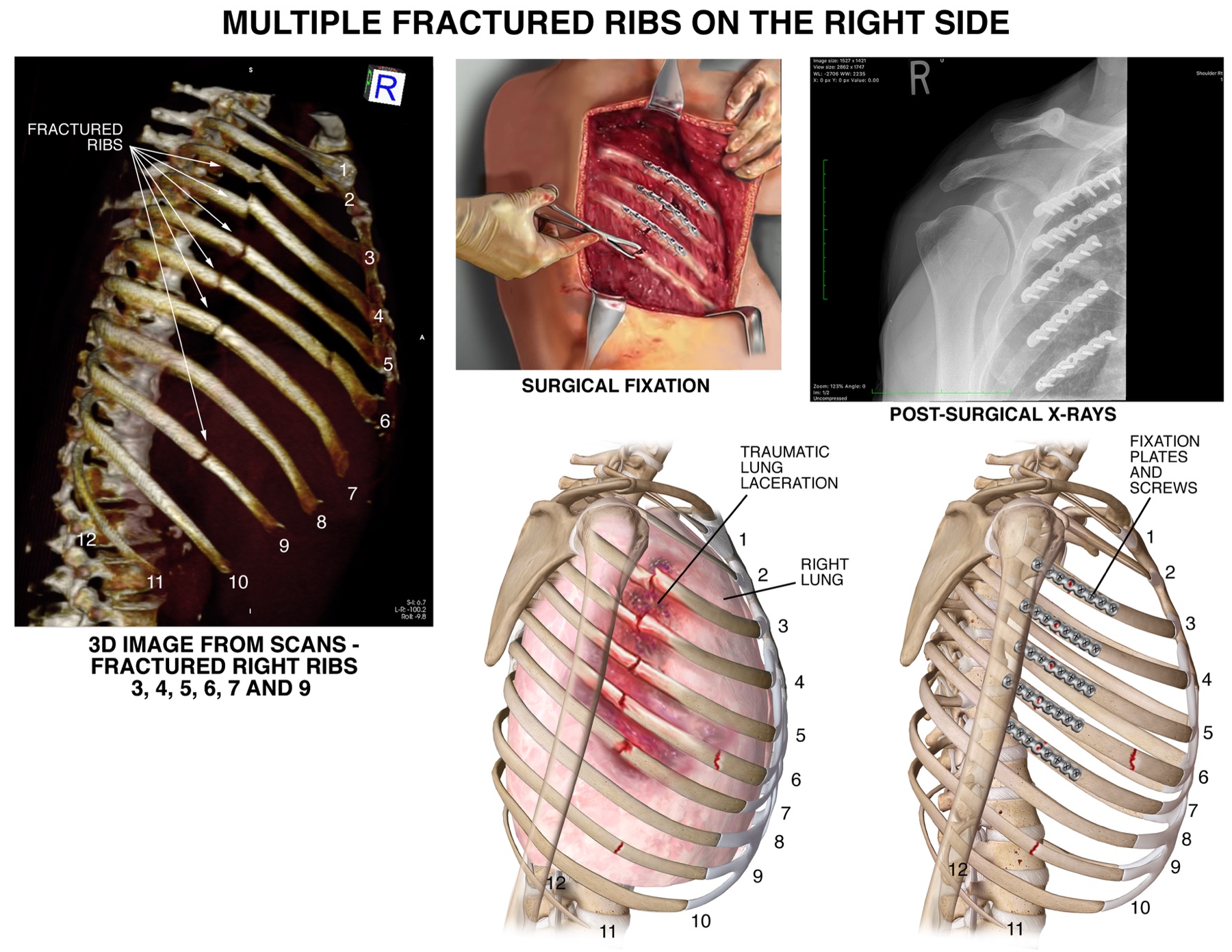 Exhibit combining 3D CT of fractured ribs, surgical fixation illustration, and post-operative x-ray